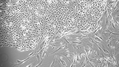 Isolierte Zellen aus einem Pleuraerguss