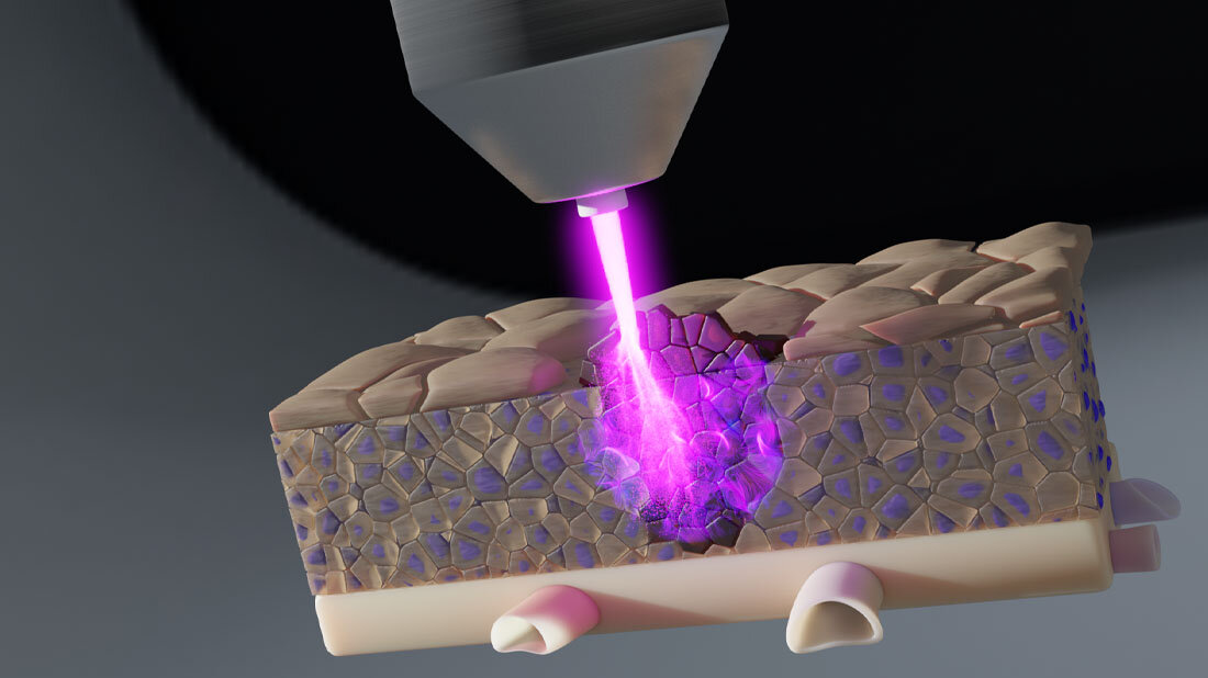 Symbolbild eines kalten Plasmastrahls, der ins Gewebe eindringt.