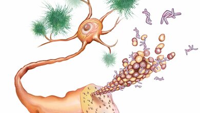 Plaques__Neuron_Plaques_und_Fibrillen.jpg Beta-Amyloid und Tau-Fibrillen