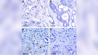 Probe Bauchspeicheldrüsenkrebs