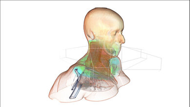 Simulierte_Dosisverteilung_des_Bestrahlungsplans_Fraunhofer_MEVIS_10062016.jpg Simulierte Dosisverteilung