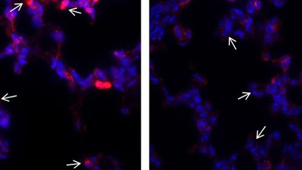 Bronchopulmonale Dysplasie