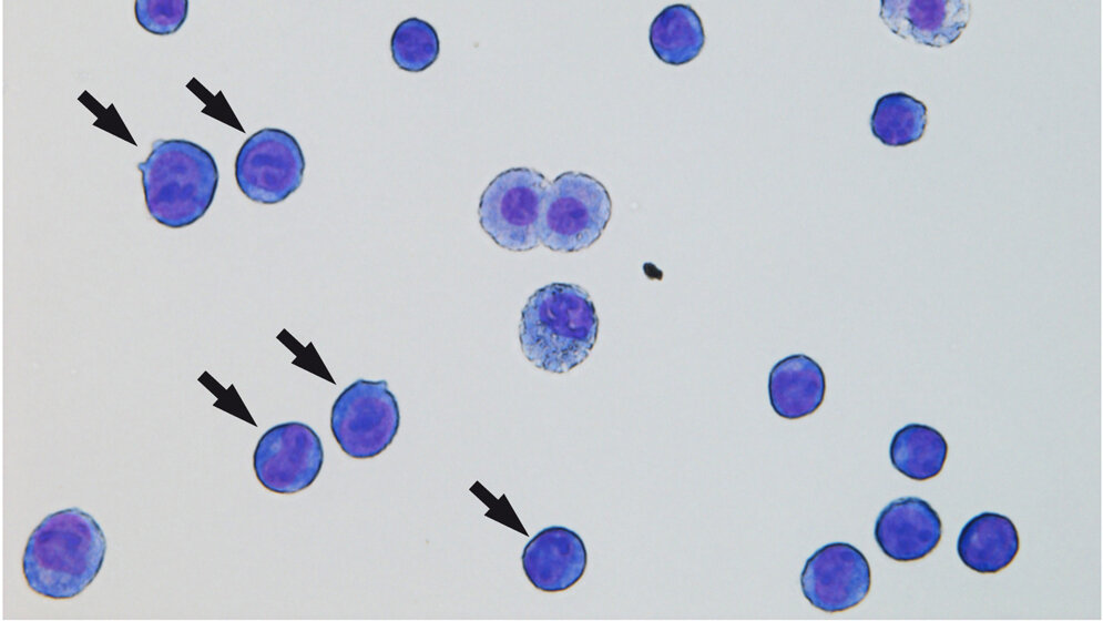 AML1-ETO führt zu Blasten 