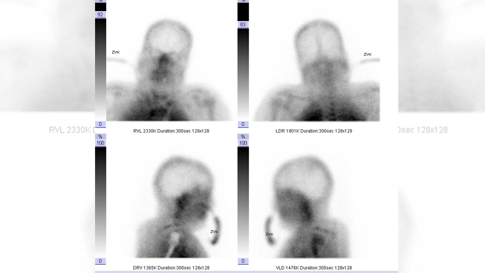Fehlende Hirnperfusion 