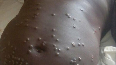 Patient mit Affenpocken 