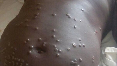 Patient_mit_Affenpocken_Nigerianische_Seuchenschutzbehoerde.jpg Patient mit Affenpocken
