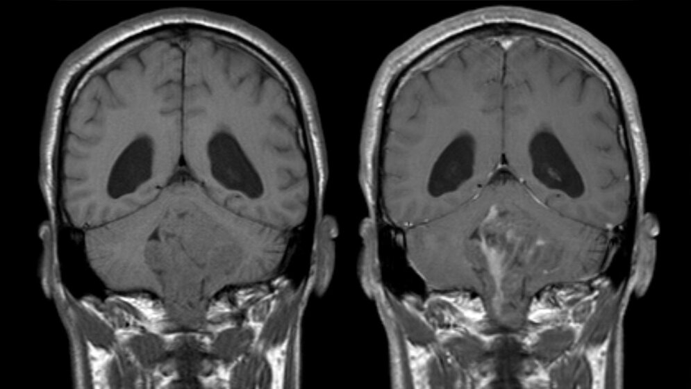 Ependymom_des_vierten_Ventrikels_coronar_Hellerhoff_eigenes_Werk_CC_BY_SA_3_0.jpg Ependymom des 4. Ventrikels