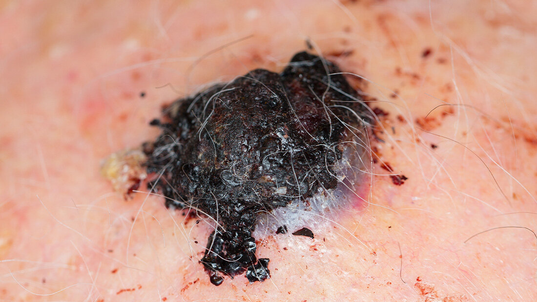 Melanomforschung: Biomarker zeigt IL-17 zeigt, wer von der Immuncheckpoint-Therapie profitiert