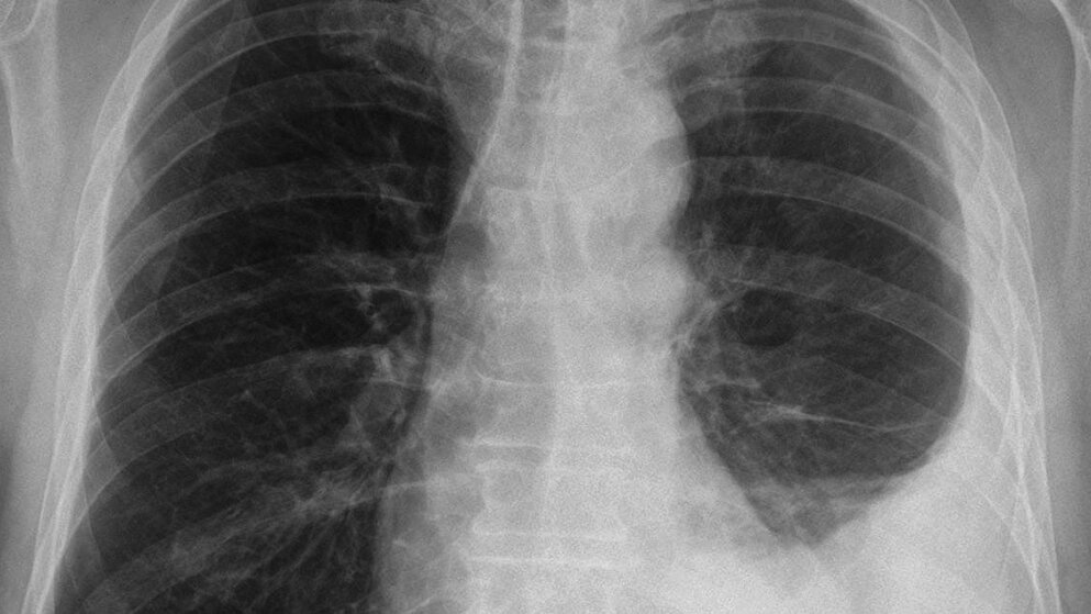 Das Pleuramesotheliom