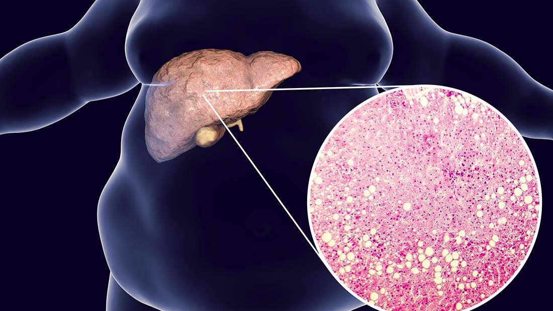 Würzburger Fettleberkohorte liefert neue Therapieansätze.
