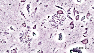 Alzheimer_dementia_presenile_onset_KGH_CC_BY_SA_3via_Wikimedia_02022016.jpg Senile Plaques