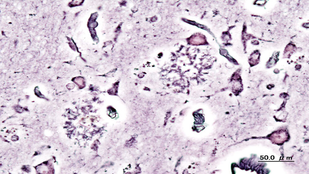 Senile Plaques