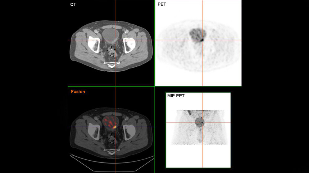 Blasenkrebs in der FDG-PET/CT-Darstellung 