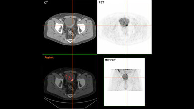 Blasenkrebs in der FDG-PET/CT-Darstellung 