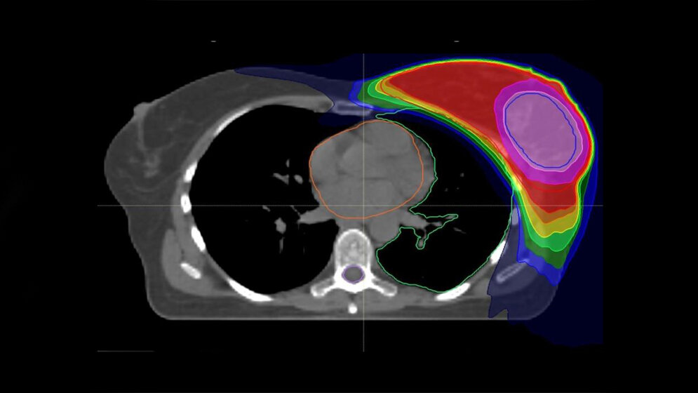 Kürzere Bestrahlungszeit bei Brustkrebs 