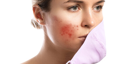 Maskendermatitis