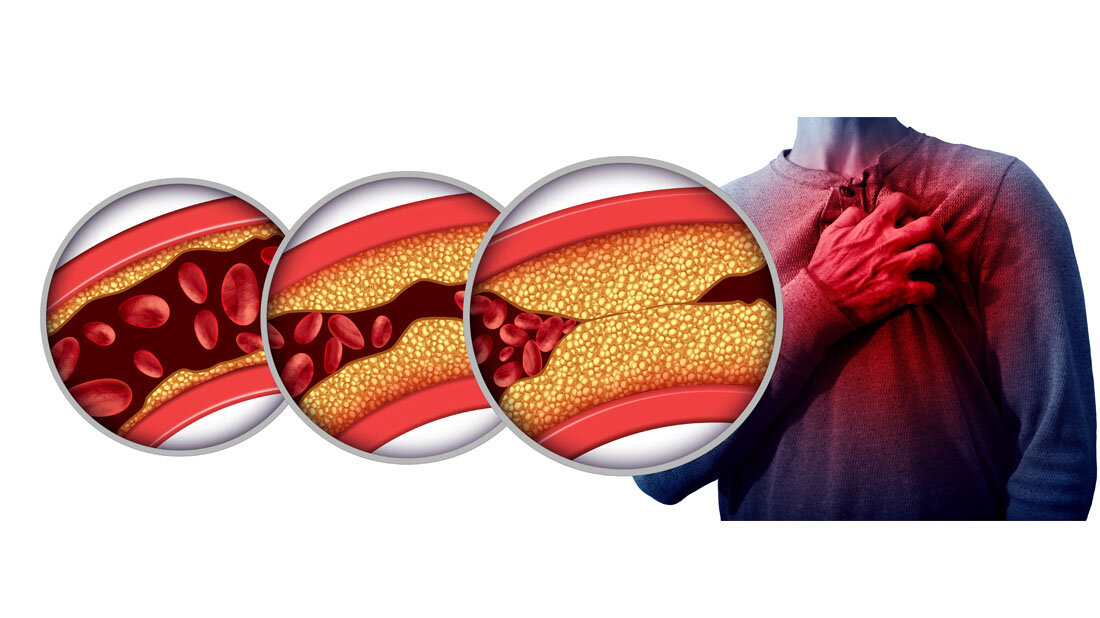 Atherosklerose.jpg Atherosklerose