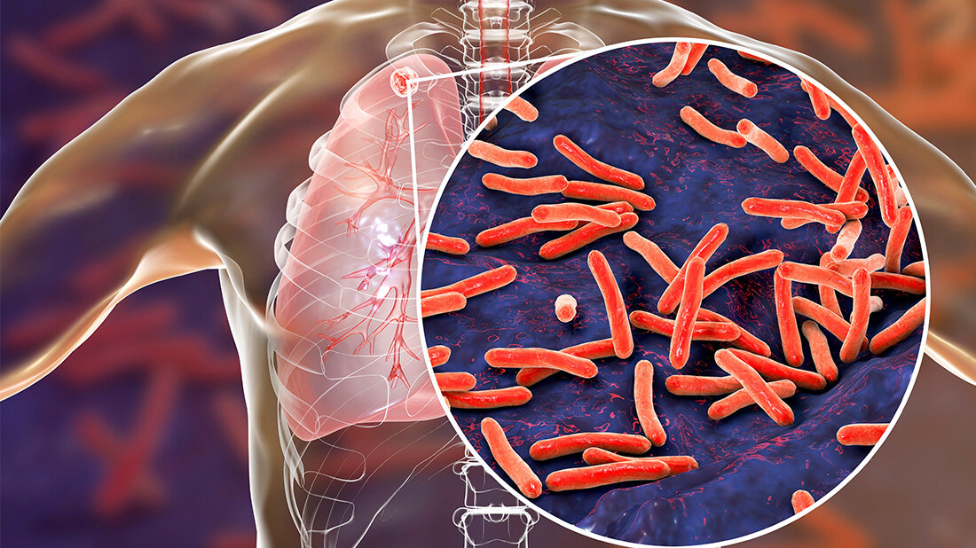 Multiresistente_Tuberkulose.jpg Molekulare Vorhersage von Antibiotikaresistenzen bei Tuberkulose