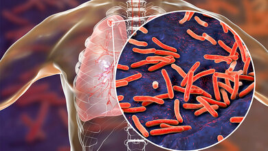 Molekulare Vorhersage von Antibiotikaresistenzen bei Tuberkulose