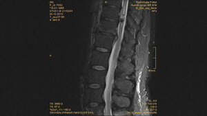 Schnittbilddiagnostik der Wirbelsäule