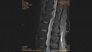 Schnittbilddiagnostik der Wirbelsäule