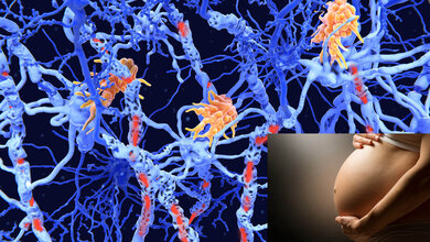 Folgen von MS auf die Myelinscheiden sowie ein Bild einer Schwangeren.