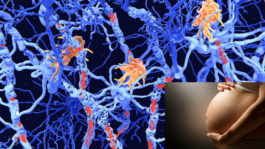 Folgen von MS auf die Myelinscheiden sowie ein Bild einer Schwangeren.