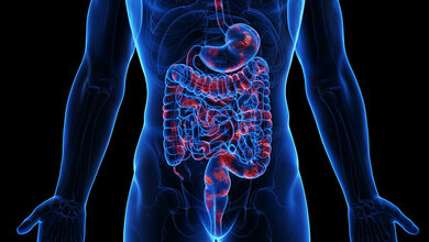 colitis_ulcerosa.jpg Colitis ulcerosa