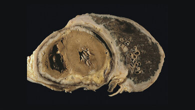 Mesotheliom_Praeparat.jpg Diffuses pleurales Mesotheliom