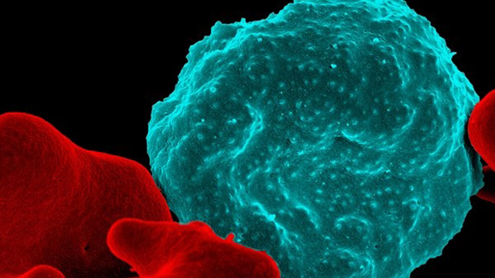 Rote Blutzelle, die mit Malaria infiziert ist 