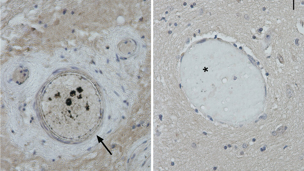 Schädel-Hirn-Verletzungen