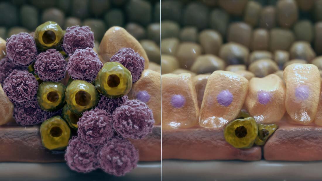 Progesteronhemmer reduziert Brustkrebsrisiko 