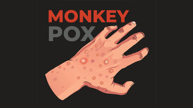Hand mit Mpox