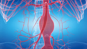 Illustration eines Aneurysmas (sackförmige Erweiterung des Gefäßes)