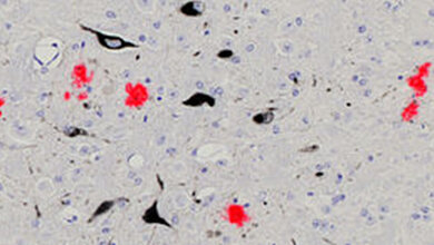 Alzheimer_Eiweissablagerungen.jpg Alzheimer_Eiweissablagerungen.jpg