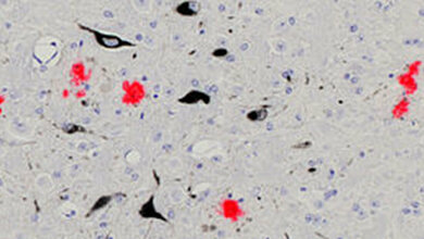 Alzheimer_Eiweissablagerungen.jpg Alzheimer_Eiweissablagerungen.jpg