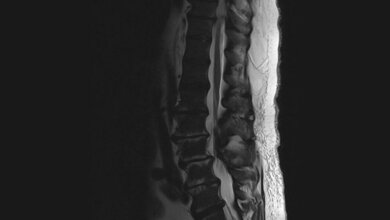 Tumoröse Veränderungen: Chronisch-myeloische Leukämie und Myelofibrose Schnittbilddiagnostik der Wirbelsäule (4.18)
