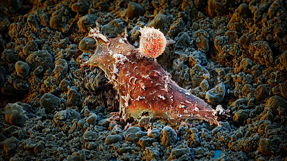 Immunzelle_Krebszelle.jpg Visualisierung, wie eine kleinere Immunzelle eine größere Krebszelle angreift