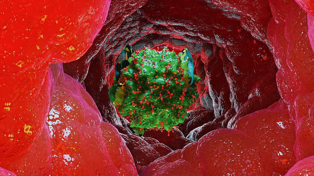 Titelbild von Teil 2 des Fachbeitrags über die Verbreitung, Diagnostik und Therapie des Mastzellaktivierungssyndroms und seine Rolle unter anderem bei Long bzw. Post COVID