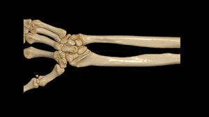 Titelbild zum Fachbeitrag zur Madelung-Deförmität