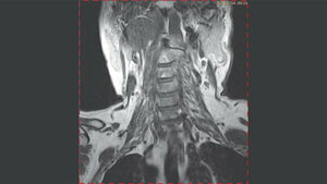 Zufallsbefunde: Laterale Halszyste
