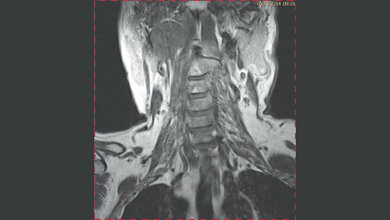Zufallsbefunde: Laterale Halszyste