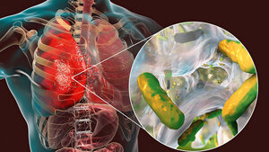 Die Grafik zeigt einen „gläsernen“ Brustkorb mit den Organen und einer Vergrößerung der Lunge, auf der Keime zu sehen sind