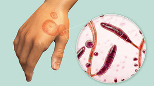 Dermatophyten und Befall der Haut auf einer Hand