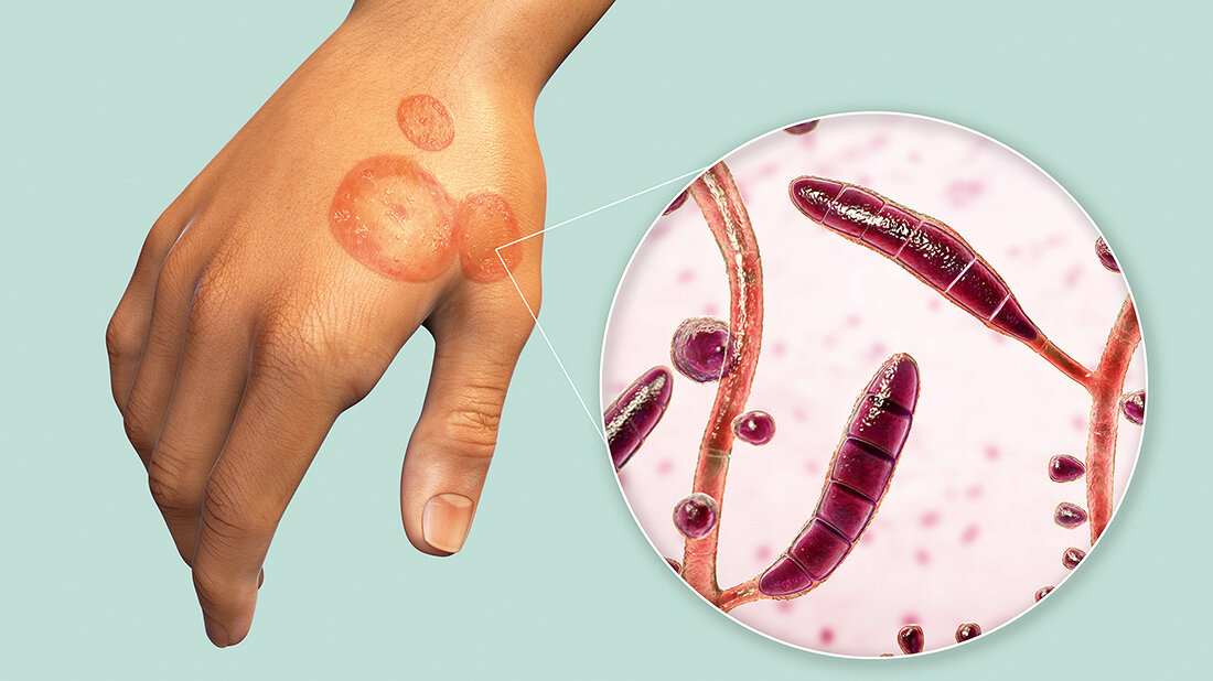 Dermatophyten und Befall der Haut auf einer Hand