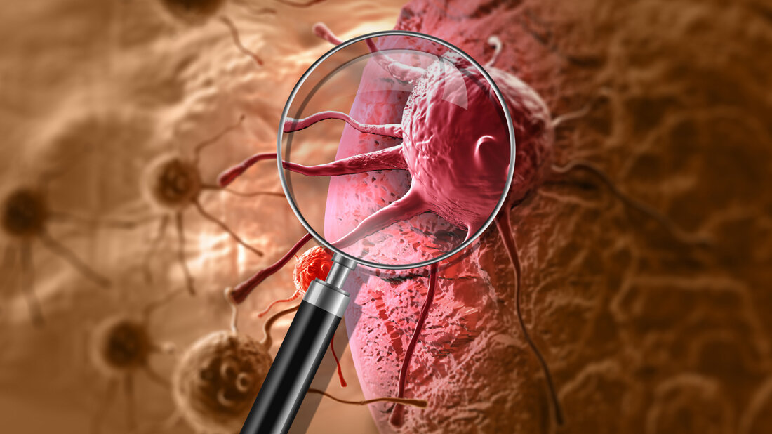 Proteinmuster z.B. bei Krebs untersuchen