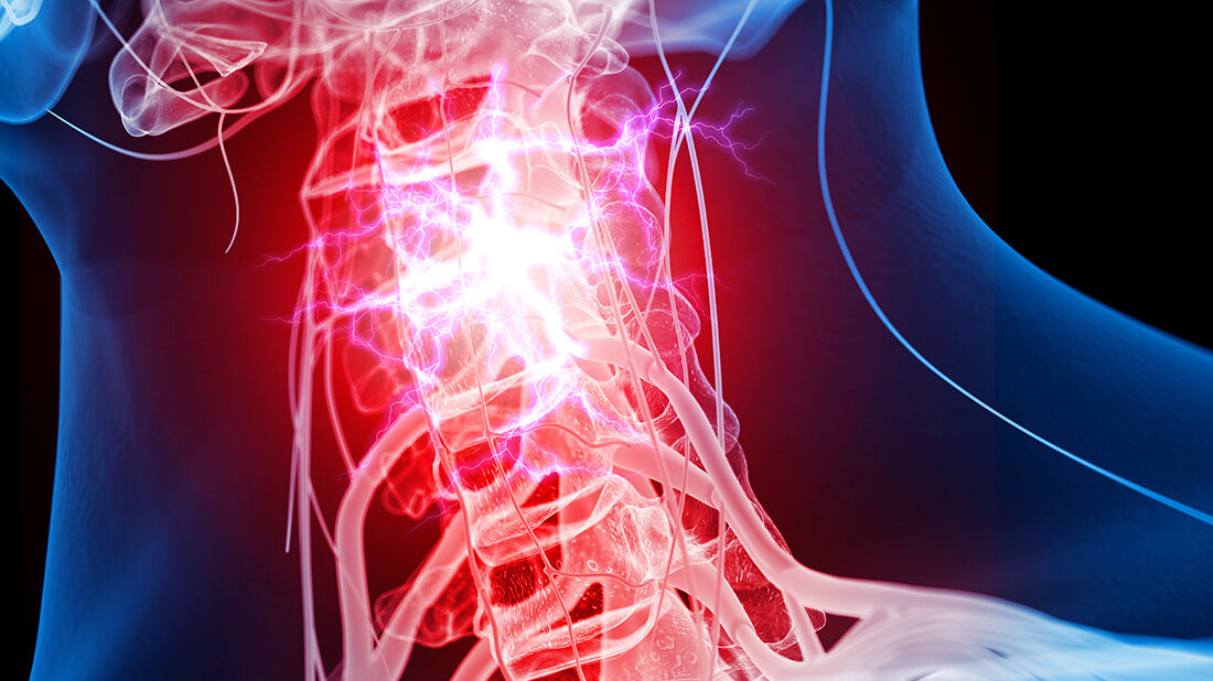 SCI.jpeg Spinal chord injury (SCI)