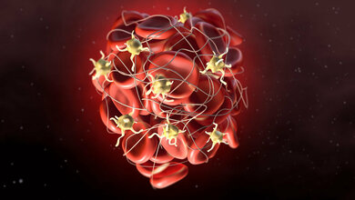 Thrombus_Adobe.jpg Blutgerinnsel