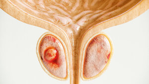Prostatakrebs Stadium 1 von 4 – Detaillierte hochwertige 3D-Darstellung