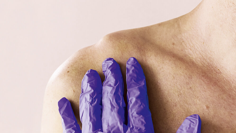 Clavicle fracture (Broken Collarbone) – Quick Facts